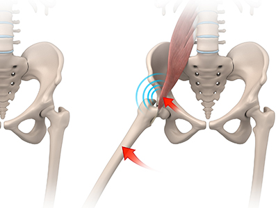 Iliopsoas Impingement - Educational Picture