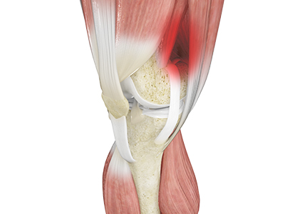Iliotibial Band Syndrome - Educational Picture