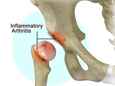 Inflammatory Arthritis of the Hip - Educational Picture
