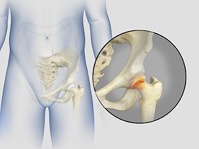 Irritable Hip - Educational Picture