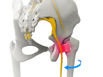 Ischiofemoral Impingement - Educational Picture
