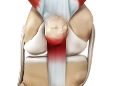 Jumper's Knee - Educational Picture