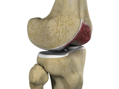 Knee Arthritis - Educational Picture