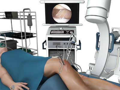 Knee Arthroscopy - Educational Picture