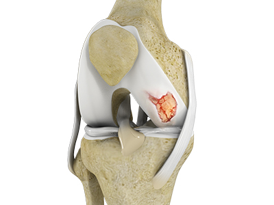 Knee Cartilage Restoration - Educational Picture