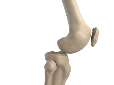 Knee Dislocation - Educational Picture