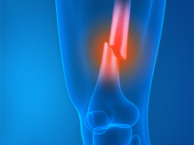 Knee Fracture - Educational Picture