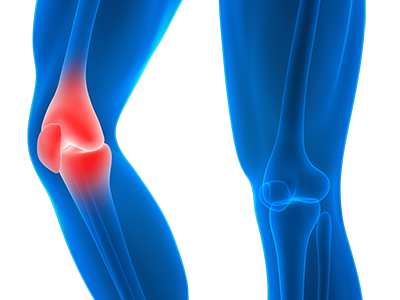 Knee Injury - Educational Picture