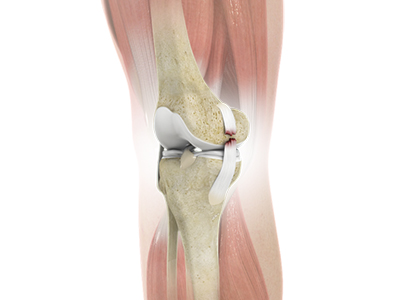 Knee Ligament Injuries - Educational Picture