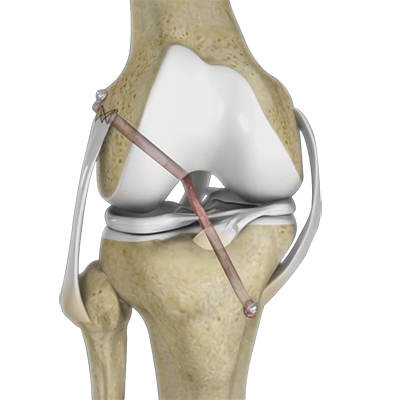 Knee Ligament Reconstruction - Educational Picture