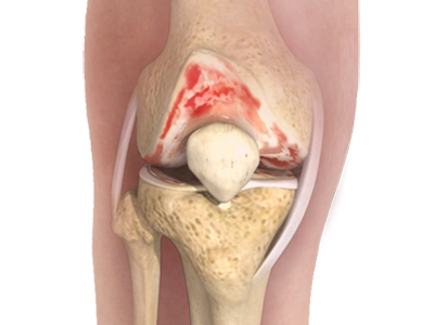 Knee Osteoarthritis - Educational Picture