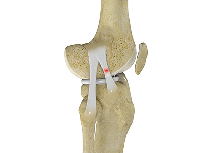 Knee Sprain - Educational Picture