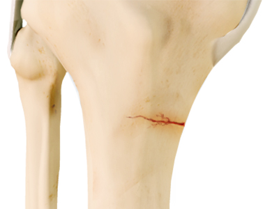 Knee Stress Fractures - Educational Picture