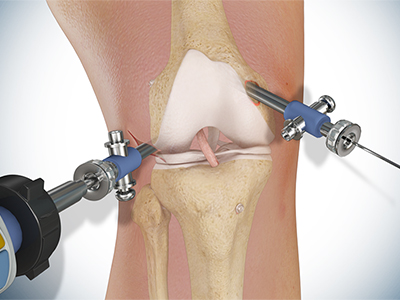 Knee Surgery - Educational Picture