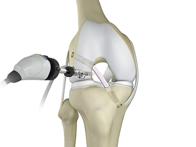 Knee Trauma - Educational Picture