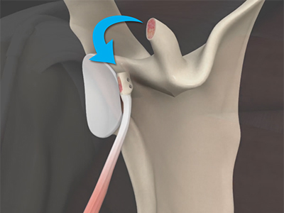 Latarjet Procedure - Educational Picture