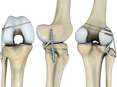 Ligament Preservation/Repair - Educational Picture