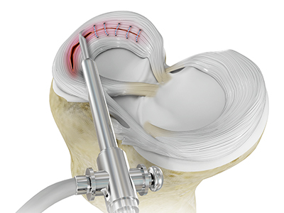 Meniscal Surgery - Educational Picture