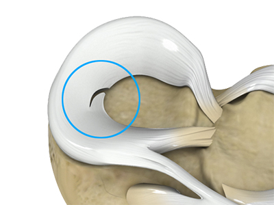 Meniscal Tears - Educational Picture