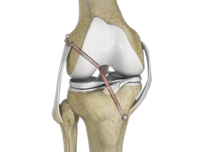 Multiligament Reconstruction of the Knee - Educational Picture