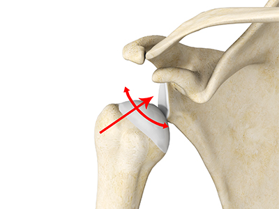 Multidirectional Instability of the Shoulder - Educational Picture