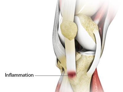 Osgood-Schlatter Disease - Educational Picture