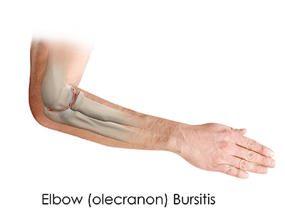 Elbow Osteoarthritis - Educational Picture