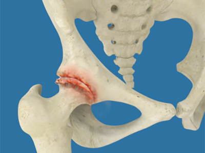 Osteoarthritis of the Hip - Educational Picture