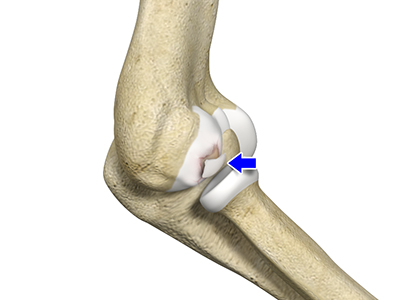 Osteochondritis Dissecans of the Elbow - Educational Picture