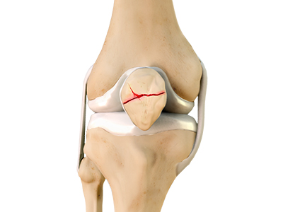Patella Fracture - Educational Picture