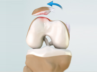 Patellar Dislocation/Patellofemoral Dislocation - Educational Picture