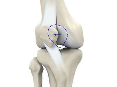 Patellar Instability - Educational Picture