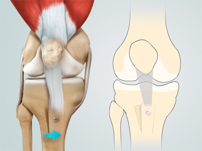 Patella Stabilization - Educational Picture