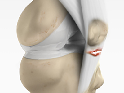 Patellar Tendon Rupture - Educational Picture