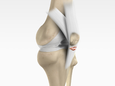 Patellar Tendon Tear - Educational Picture