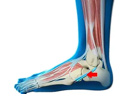 Peroneal Tendon Dislocation - Educational Picture