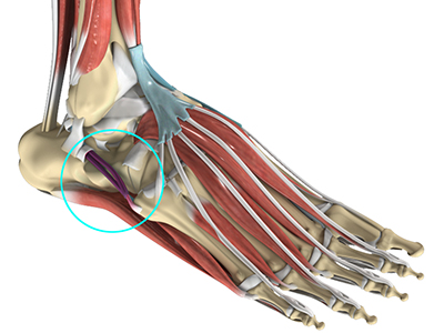 Peroneal Tendonitis - Educational Picture