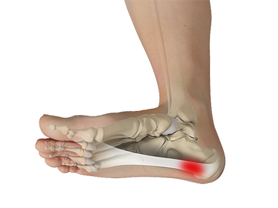 Plantar Fasciitis - Educational Picture
