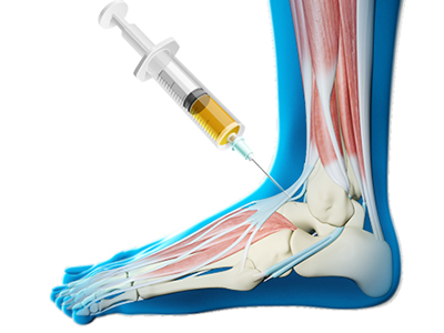 Platelet Rich Plasma (PRP) Injections for the Knee - Educational Picture