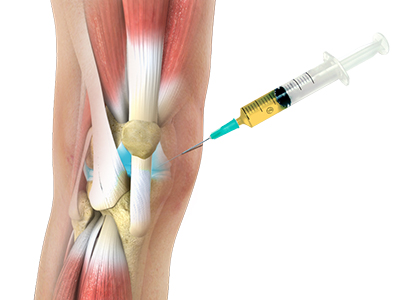 Platelet-Rich Plasma (PRP) Injection - Educational Picture