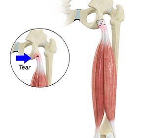 Proximal Hamstring Repair - Educational Picture