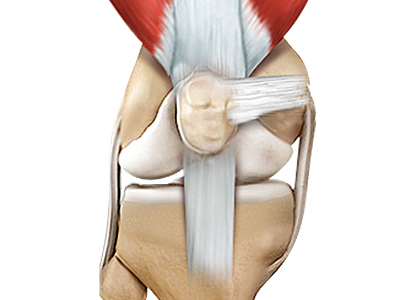 Quadriceps Tendon Repair - Educational Picture