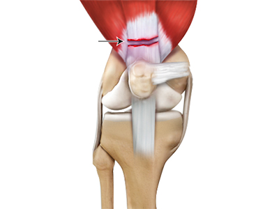 Quadriceps Tendon Rupture - Educational Picture