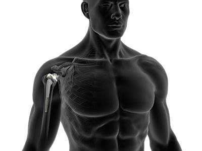 Reverse Shoulder Replacement - Educational Picture
