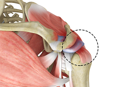 Rotator Cuff Pain - Educational Picture