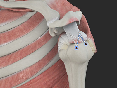 Rotator Cuff Repair - Educational Picture