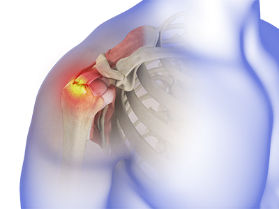 Rotator Cuff Tear - Educational Picture
