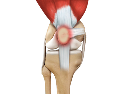 Runner's Knee - Educational Picture
