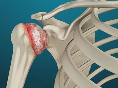 Arthritis of the Shoulder - Educational Picture