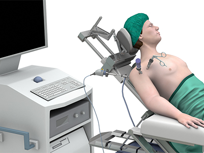 Shoulder Arthroscopy - Educational Picture